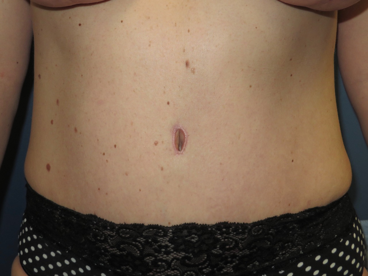 OptimalSelf MD Abdominoplasty Surgery After OptimalSelf MD Abdominoplasty Surgery After