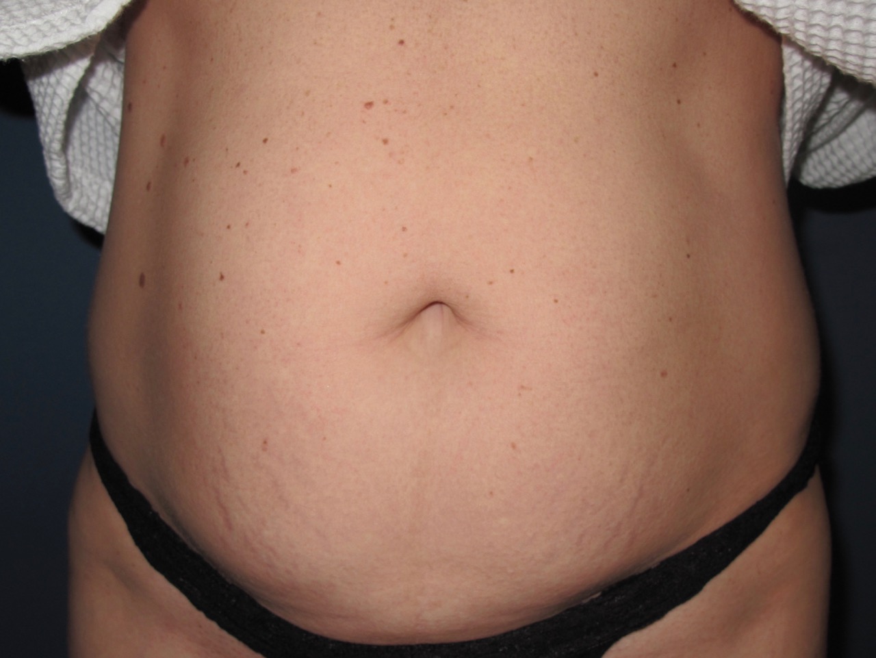 OptimalSelf MD Abdominoplasty Surgery Before OptimalSelf MD Abdominoplasty Surgery Before