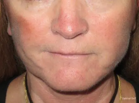 Facelift and Mini Facelift Before and After Pictures in Greenville, SC