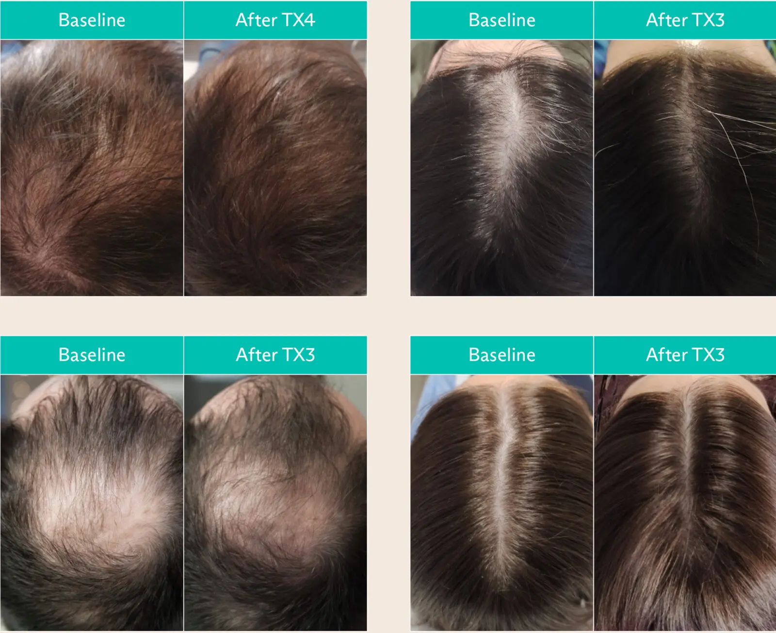 ghk-cu injections for hair growth Amazon.com: Neurogan GHK-Cu Copper Peptide Hair & Scalp Serum – 2400mg, 4% Copper Peptides – Fast-Absorbing, Water-Based Formula for Hair Softness & Shine ghk-cu injections for hair growth Amazon.com: Neurogan GHK-Cu Copper Peptide Hair & Scalp Serum – 2400mg, 4% Copper Peptides – Fast-Absorbing, Water-Based Formula for Hair Softness & Shine
