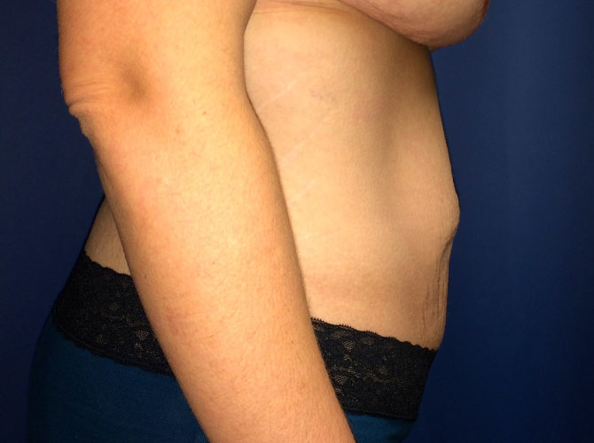 OptimalSelf MD Abdominoplasty Before OptimalSelf MD Abdominoplasty Before