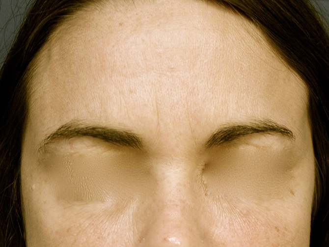 OptimalSelf MD Botox After OptimalSelf MD Botox After