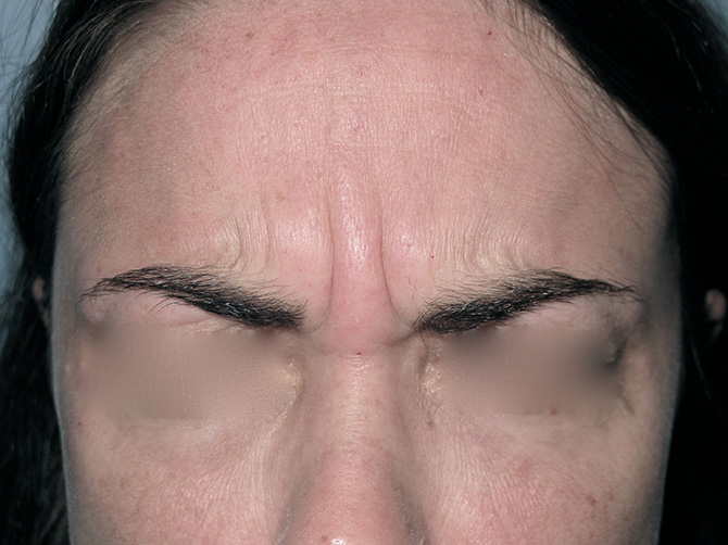 OptimalSelf MD Botox Before OptimalSelf MD Botox Before
