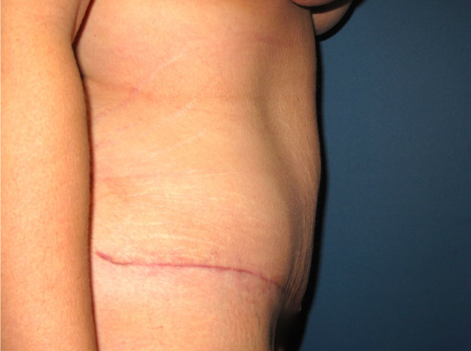 OptimalSelf MD Abdominoplasty After OptimalSelf MD Abdominoplasty After