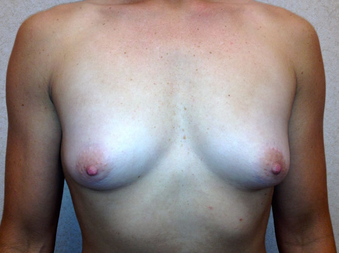 OptimalSelf MD Breast Augmentation Before OptimalSelf MD Breast Augmentation Before