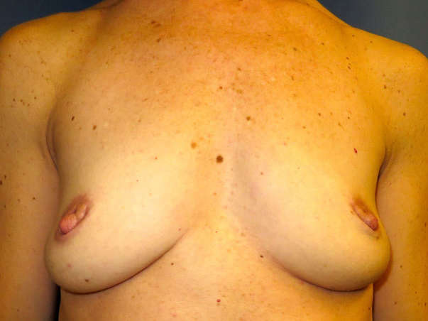 OptimalSelf MD Breast Augmentation Before OptimalSelf MD Breast Augmentation Before