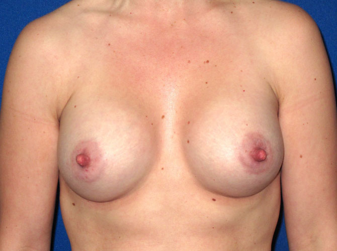 OptimalSelf MD Breast Augmentation After OptimalSelf MD Breast Augmentation After