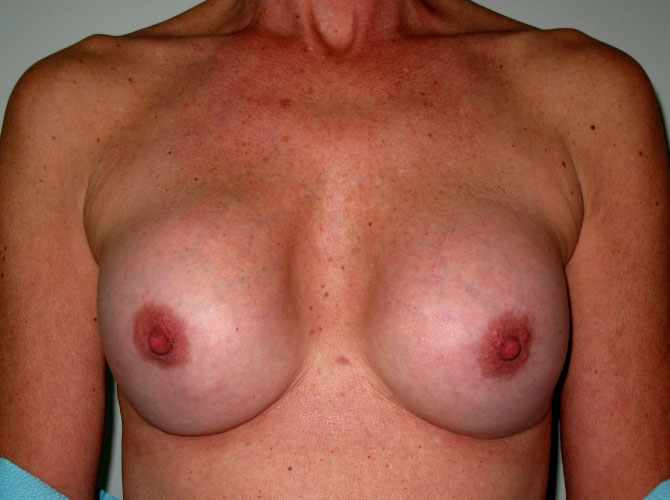OptimalSelf MD Breast Revision Before OptimalSelf MD Breast Revision Before