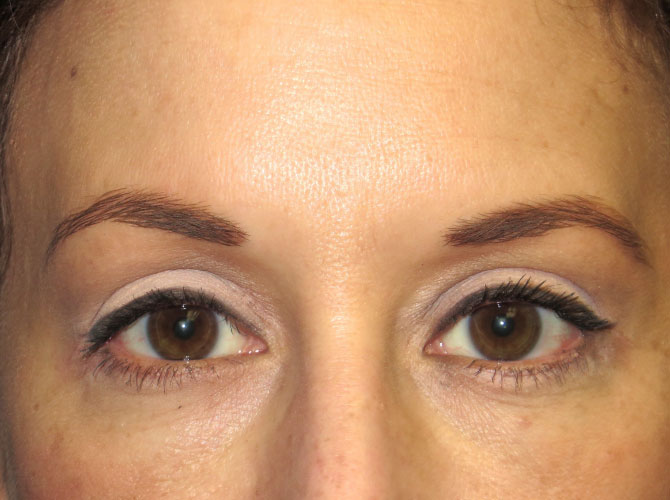 OptimalSelf MD Eyelid Surgery After OptimalSelf MD Eyelid Surgery After