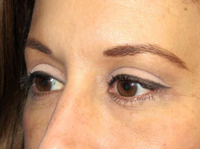 OptimalSelf MD Eyelid Surgery After OptimalSelf MD Eyelid Surgery After