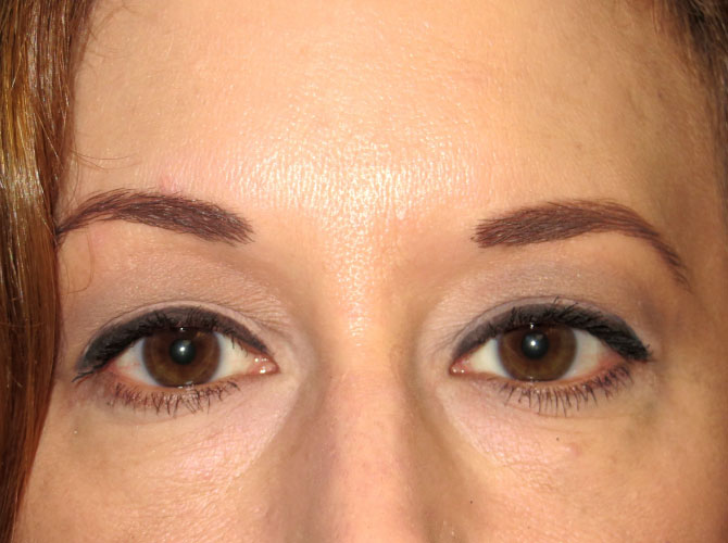 OptimalSelf MD Eyelid Surgery Before OptimalSelf MD Eyelid Surgery Before