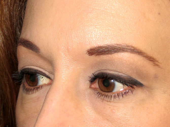 OptimalSelf MD Eyelid Surgery Before OptimalSelf MD Eyelid Surgery Before