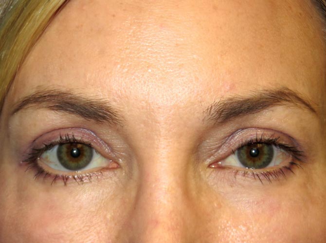 OptimalSelf MD Eyelid Surgery After OptimalSelf MD Eyelid Surgery After