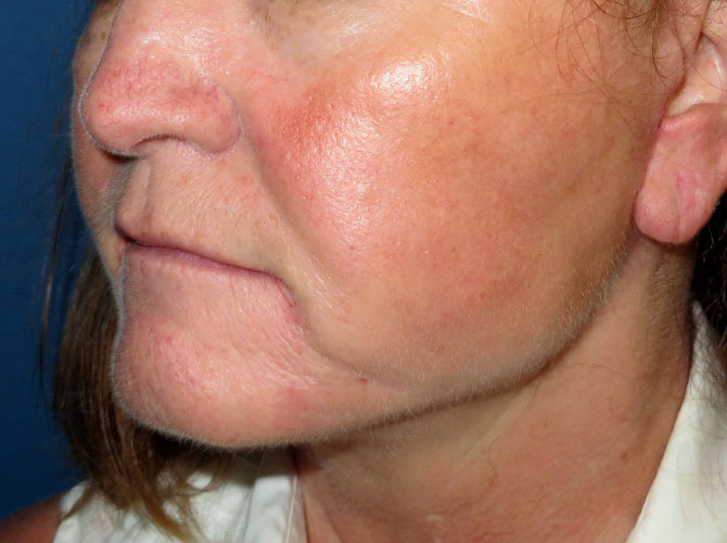 OptimalSelf MD Facelift After OptimalSelf MD Facelift After