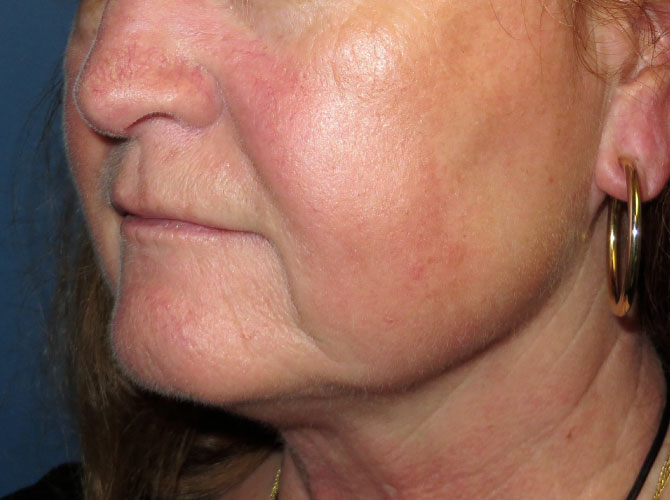 OptimalSelf MD Facelift Before OptimalSelf MD Facelift Before