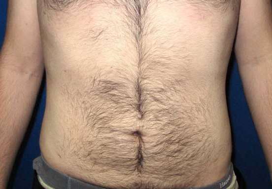 OptimalSelf MD Male Liposuction After OptimalSelf MD Male Liposuction After