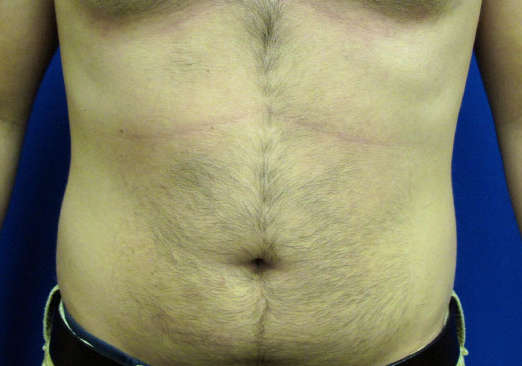 OptimalSelf MD Male Liposuction Before OptimalSelf MD Male Liposuction Before