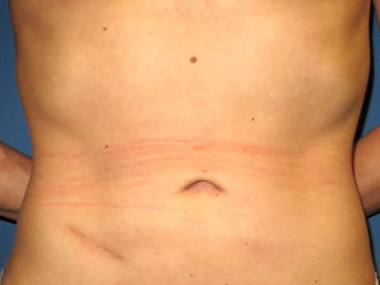 OptimalSelf MD Liposuction After OptimalSelf MD Liposuction After