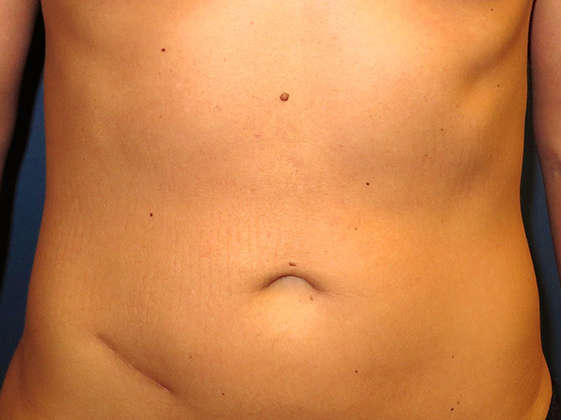 OptimalSelf MD Liposuction Before OptimalSelf MD Liposuction Before