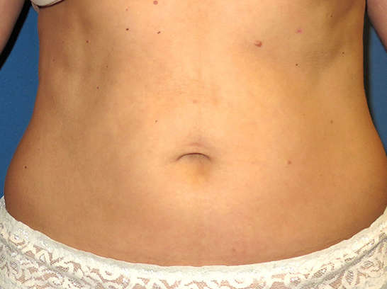 OptimalSelf MD Liposuction Before OptimalSelf MD Liposuction Before