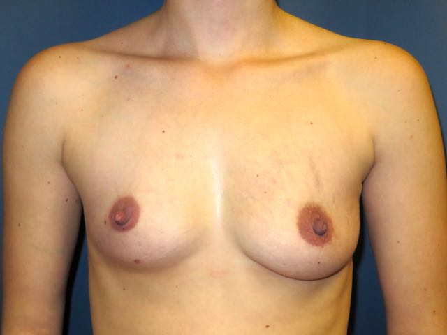 OptimalSelf MD Breast Augmentation Surgery Before OptimalSelf MD Breast Augmentation Surgery Before