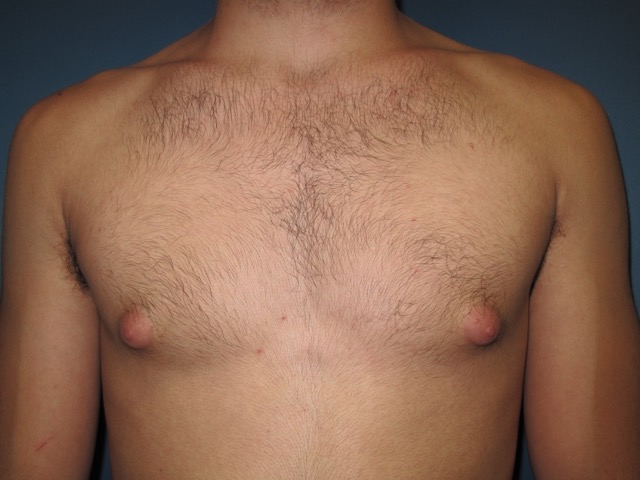 OptimalSelf MD Gynecomastia Surgery Before OptimalSelf MD Gynecomastia Surgery Before