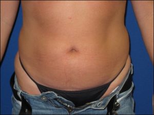 Liposuction Before and After Pictures in Greenville, SC