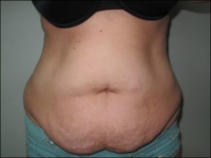 Liposuction Before and After Pictures in Greenville, SC