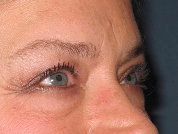OptimalSelf MD Eyelid Surgery Before OptimalSelf MD Eyelid Surgery Before