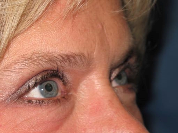 OptimalSelf MD Eyelid Surgery After OptimalSelf MD Eyelid Surgery After