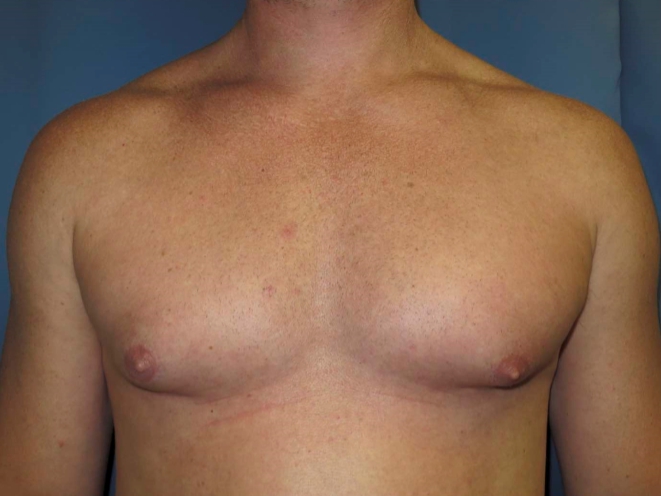 OptimalSelf MD Gynecomastia Before OptimalSelf MD Gynecomastia Before