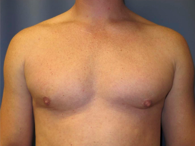 OptimalSelf MD Gynecomastia After OptimalSelf MD Gynecomastia After