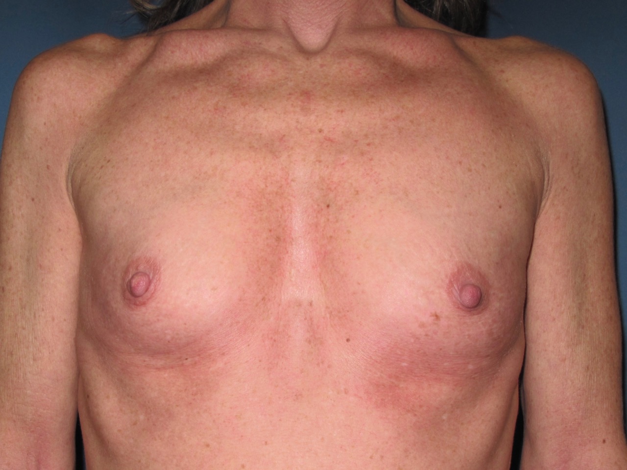 OptimalSelf MD Breast Augmentation Before OptimalSelf MD Breast Augmentation Before