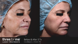 Laser Skin Resurfacing with Icon™ Before and After Pictures Greenville, SC