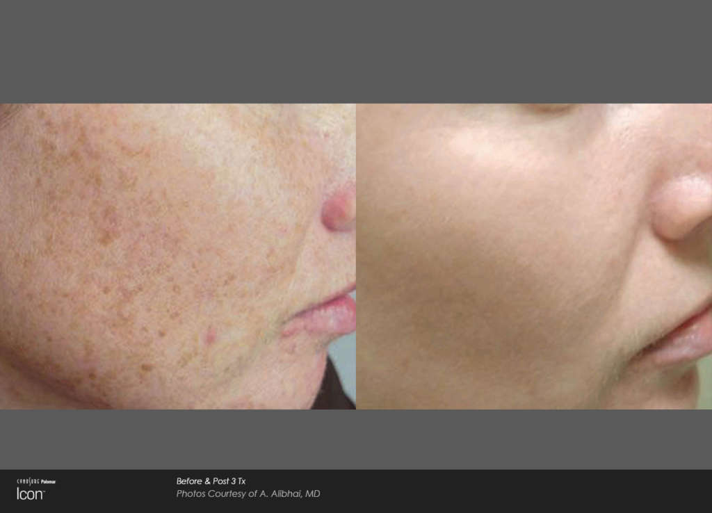 Icon Facial Rejuvenation Laser Treatment Patient Before and After