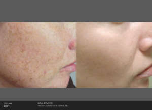 Laser Skin Resurfacing with Icon™ Before and After Pictures Greenville, SC
