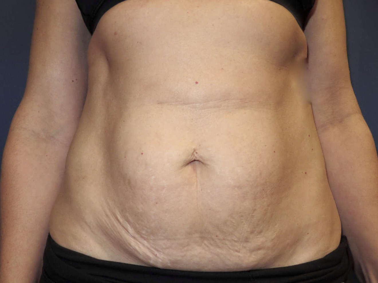 before photo of abdominoplasty patient - front view before photo of abdominoplasty patient - front view