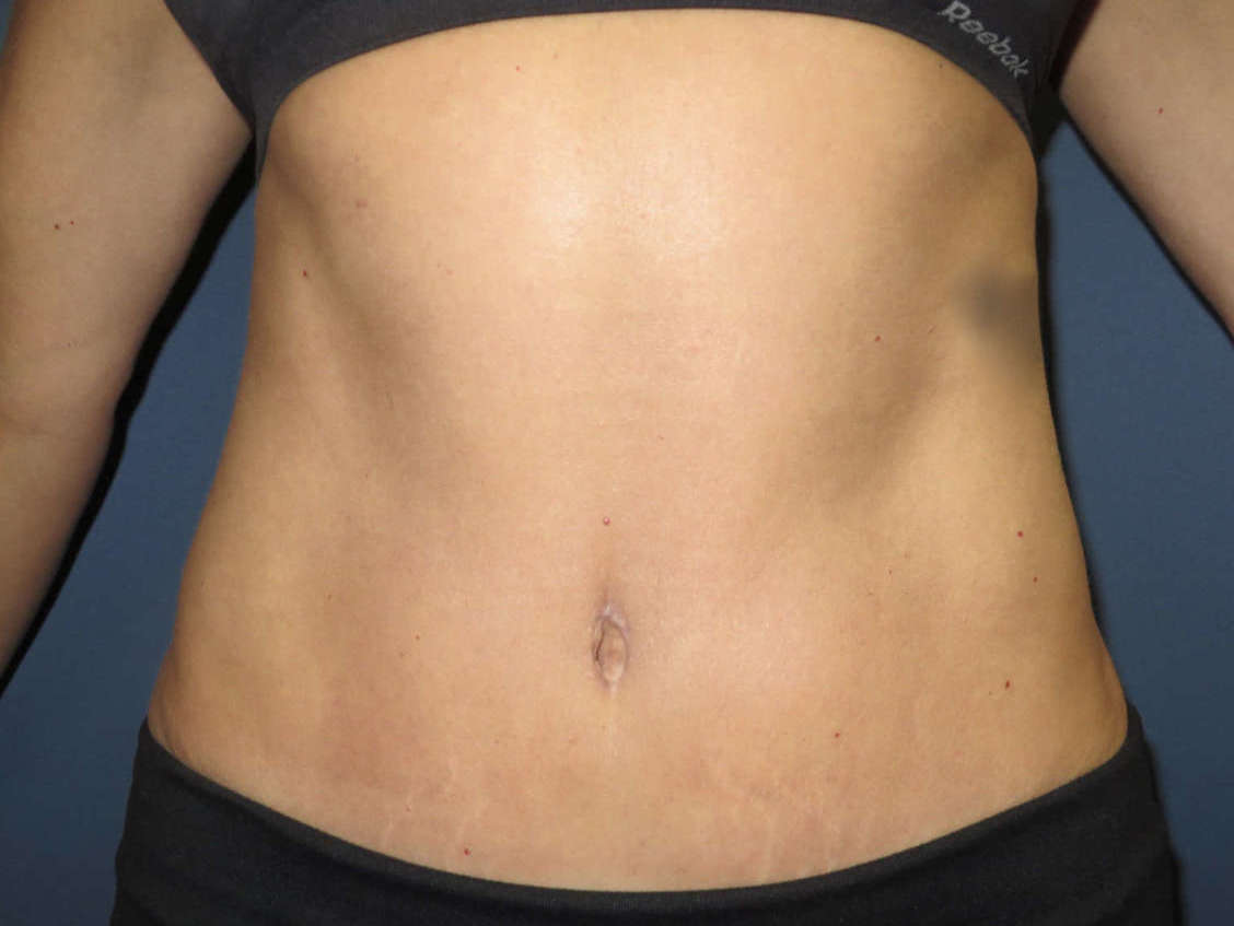 after photo of abdominoplasty patient - front view after photo of abdominoplasty patient - front view