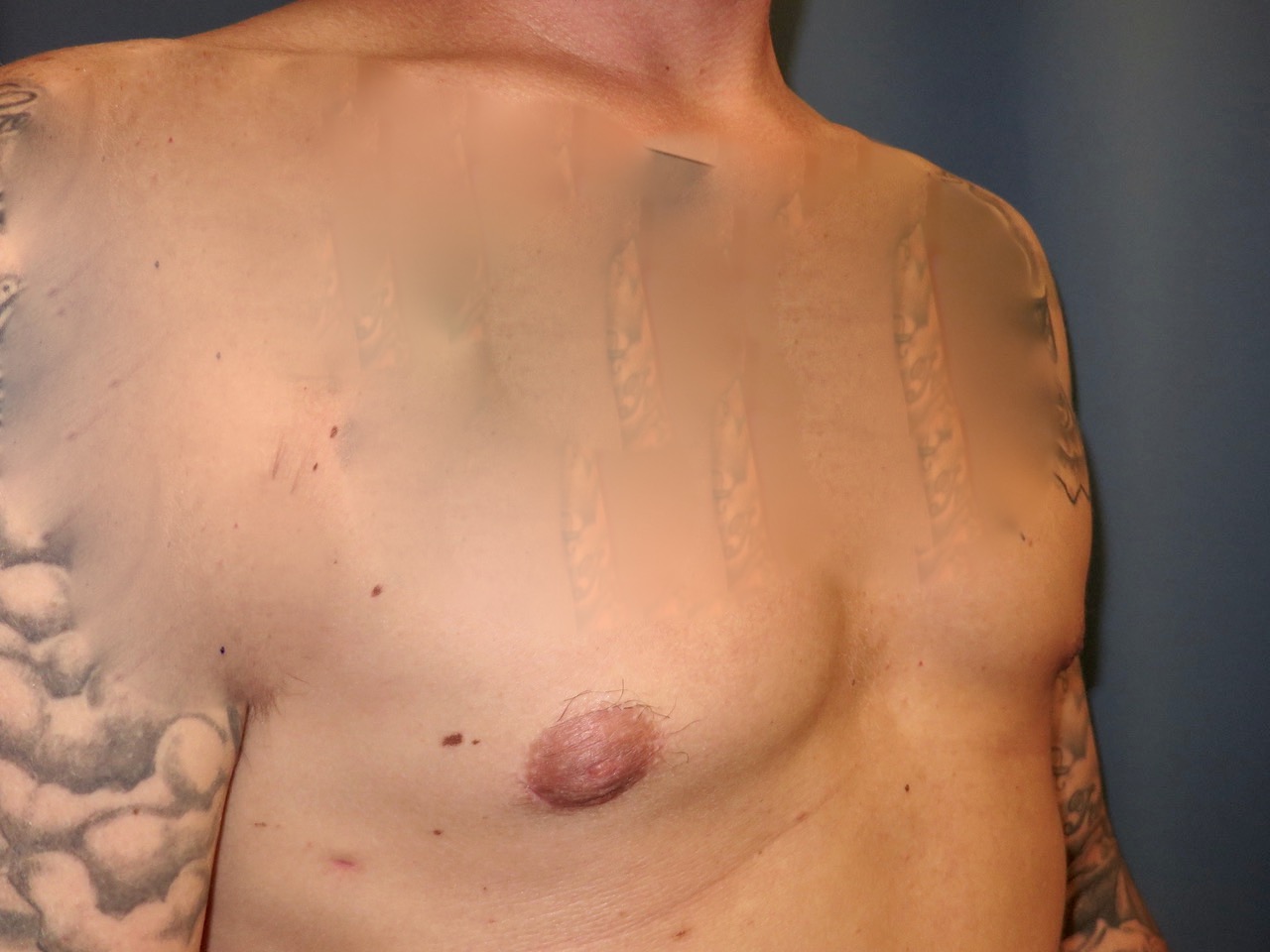after photo of gynecomastia patient - side view after photo of gynecomastia patient - side view