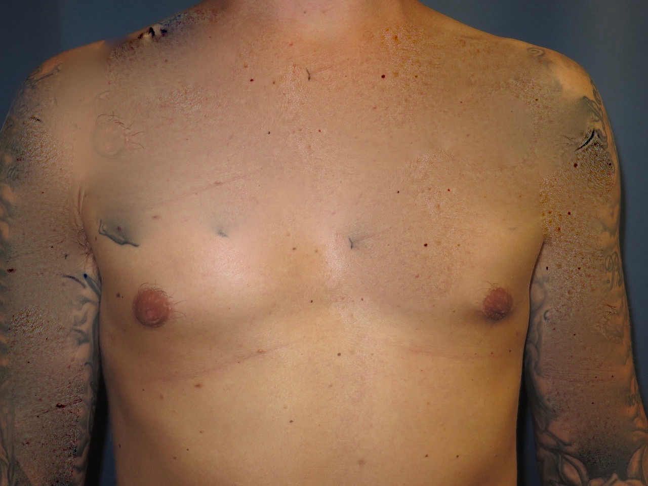 after photo of gynecomastia surgery patient - front view after photo of gynecomastia surgery patient - front view