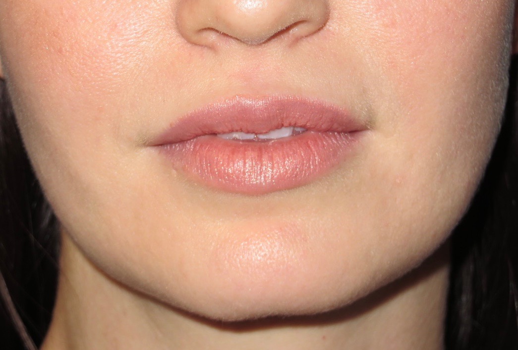 after photo of juvederm patient - front view after photo of juvederm patient - front view