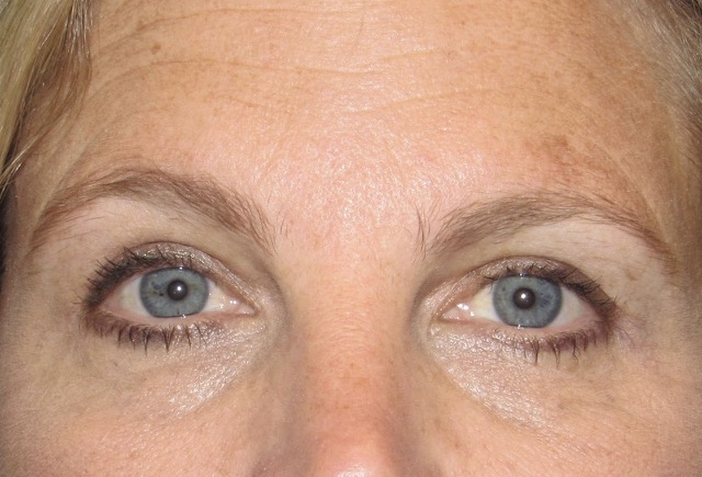 after photo of eyelid surgery patient - front view after photo of eyelid surgery patient - front view