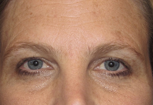 before photo of eyelid surgery patient - front view before photo of eyelid surgery patient - front view