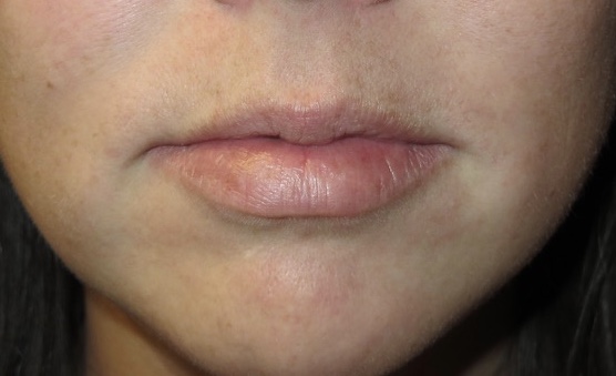 before photo of juvederm patient - front view before photo of juvederm patient - front view