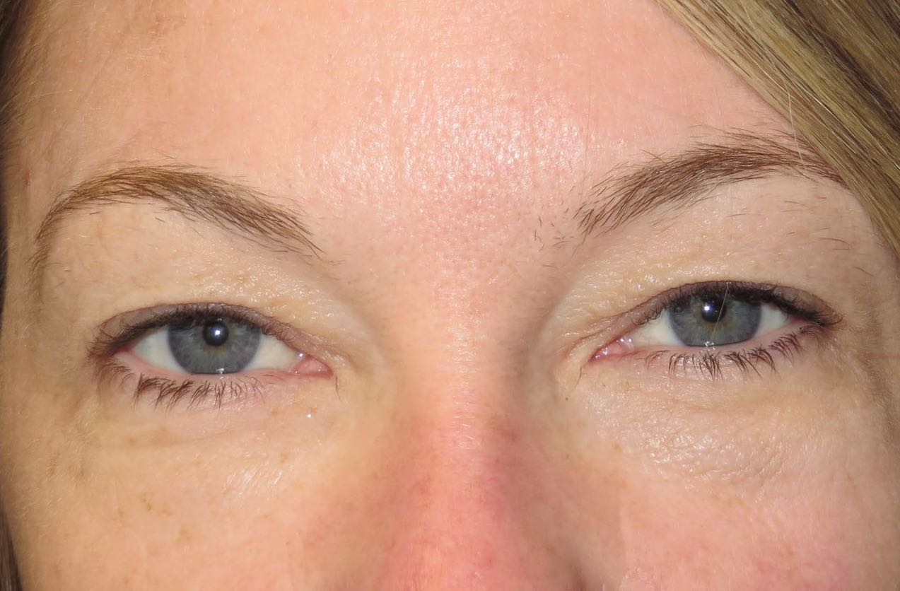 before photo of eyelid surgery patient - front view before photo of eyelid surgery patient - front view