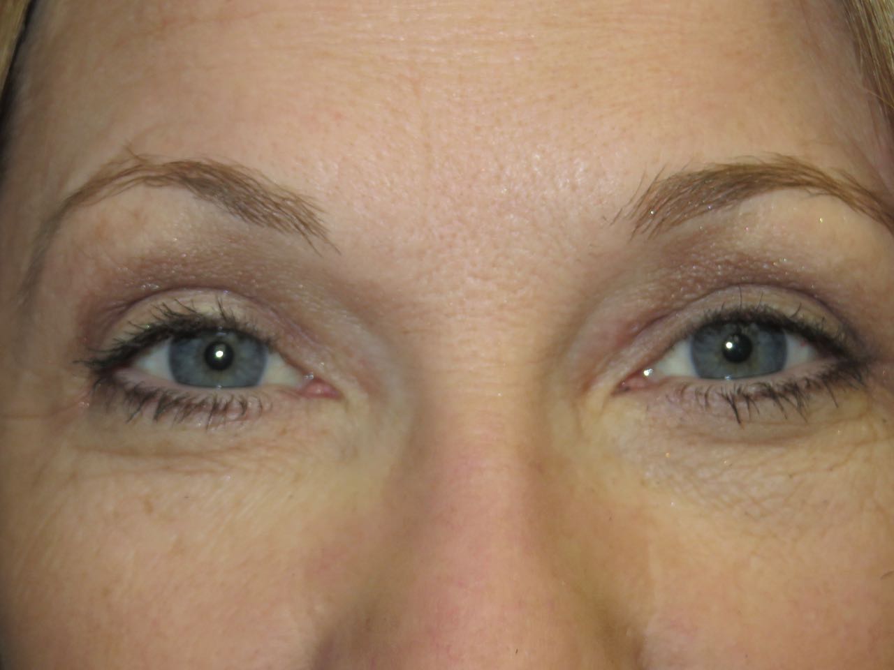 after photo of eyelid surgery patient - front view after photo of eyelid surgery patient - front view