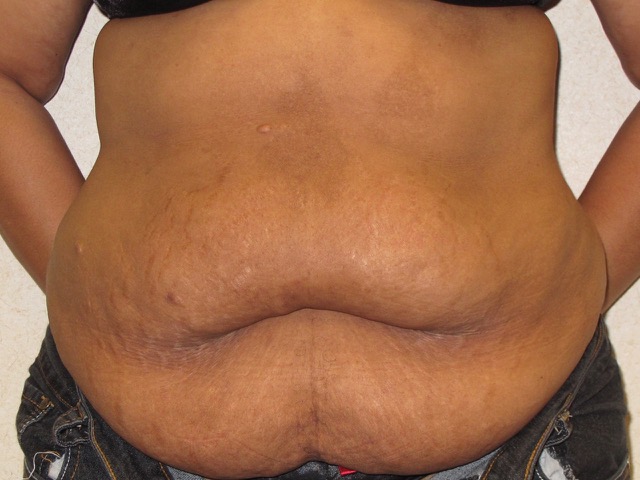 before photo of abdominoplasty patient - front view before photo of abdominoplasty patient - front view