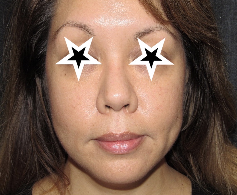 before photo of juvederm voluma patient - front view before photo of juvederm voluma patient - front view