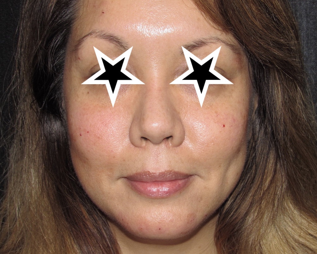 after photo of juvederm voluma patient - front view after photo of juvederm voluma patient - front view