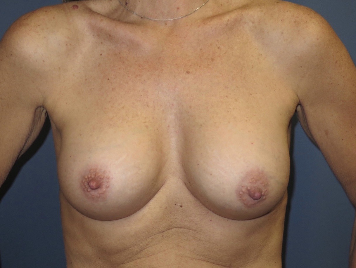 after photo of breast augmentation patient - front view after photo of breast augmentation patient - front view